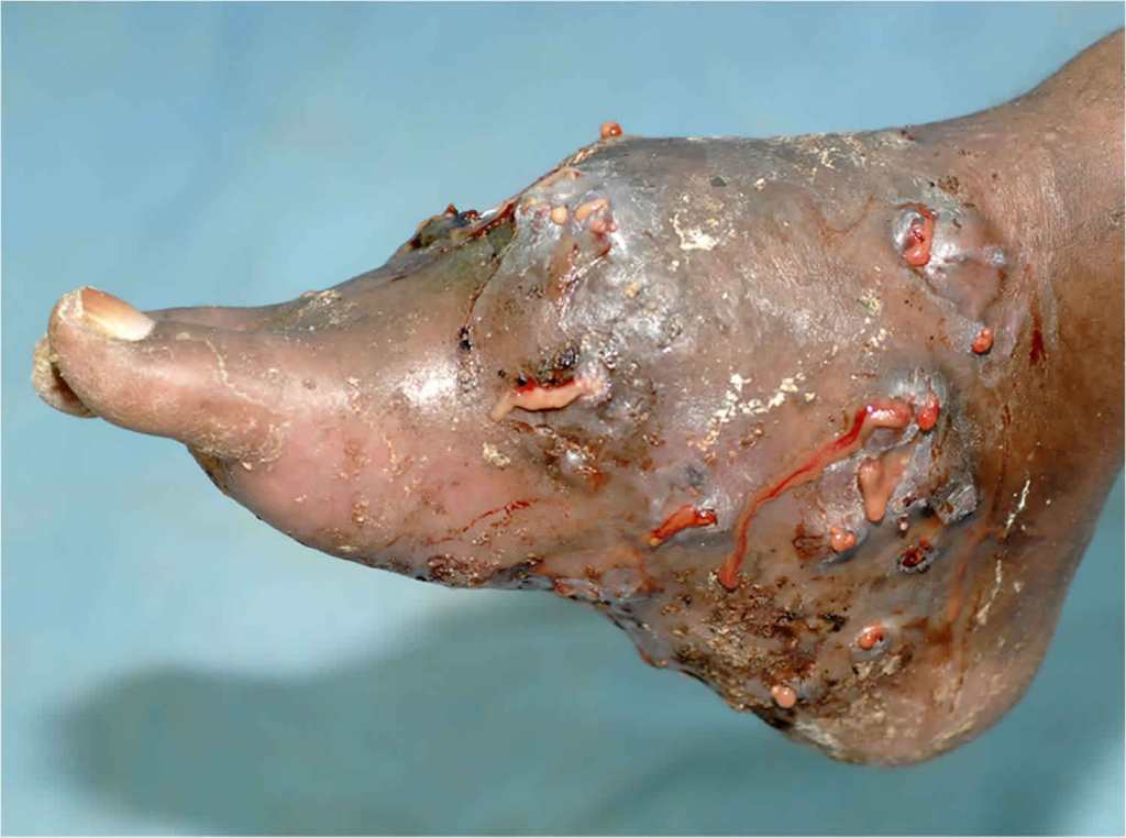 Image of foot badly affected by mycetoma, with cuts, swelling and bleeding
