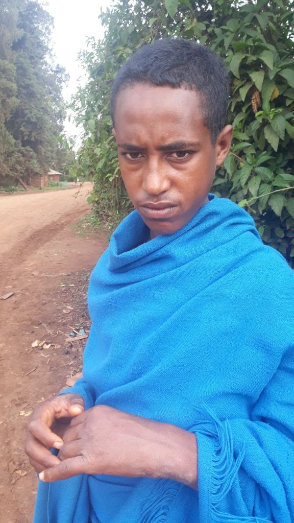 A religious student in the Amhara region of Ethiopia shows his scabies scars